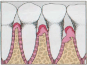 Periodontitis
